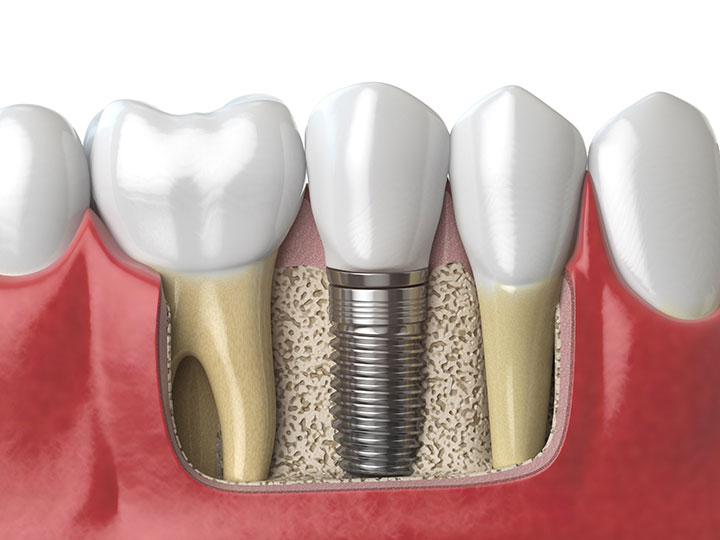 Dental Implants Types and Benefits